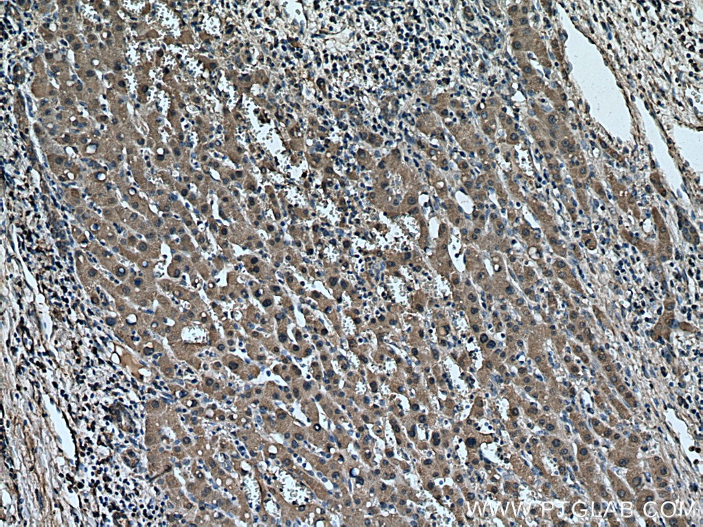 Immunohistochemistry (IHC) staining of human liver cancer tissue using GPT/ALT1 Monoclonal antibody (67531-1-Ig)