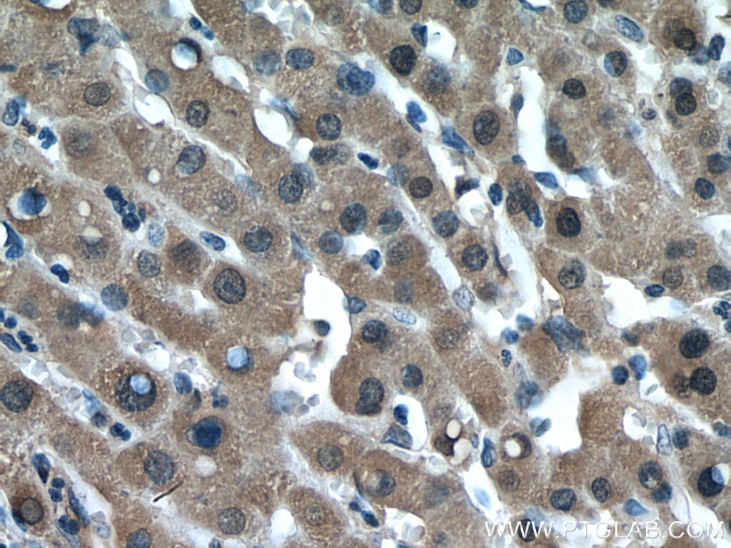 Immunohistochemistry (IHC) staining of human liver cancer tissue using GPT/ALT1 Monoclonal antibody (67531-1-Ig)