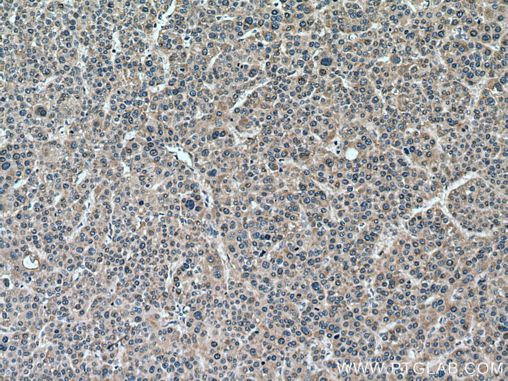Immunohistochemistry (IHC) staining of human liver cancer tissue using GPT/ALT1 Monoclonal antibody (67531-1-Ig)