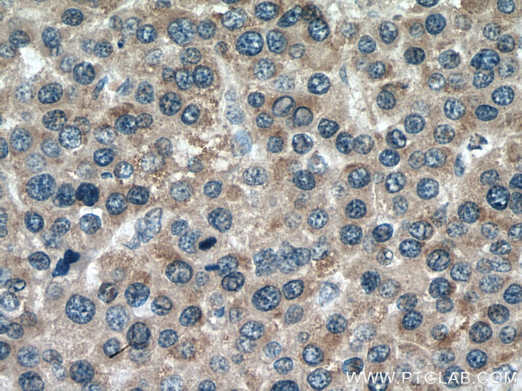 Immunohistochemistry (IHC) staining of human liver cancer tissue using GPT/ALT1 Monoclonal antibody (67531-1-Ig)