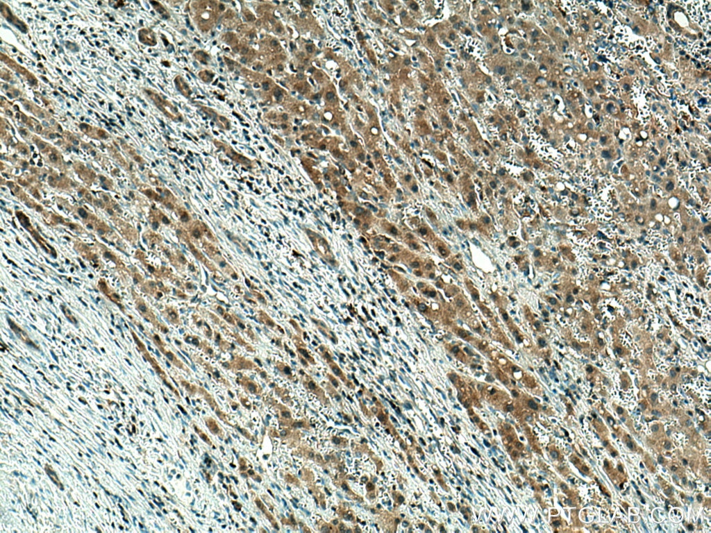 Immunohistochemistry (IHC) staining of human liver cancer tissue using GPX4 Monoclonal antibody (67763-1-Ig)