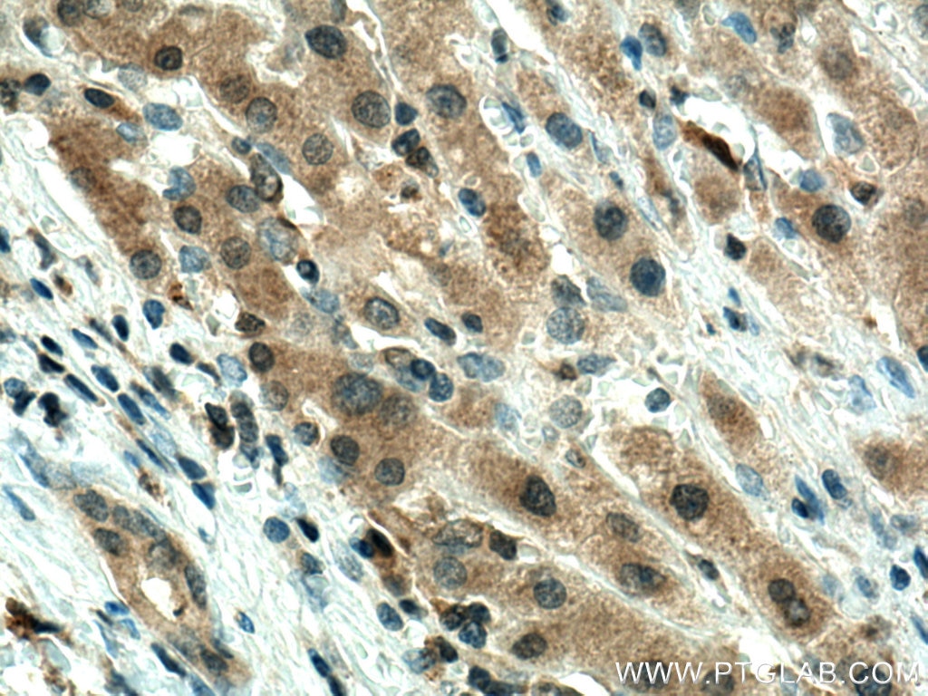 Immunohistochemistry (IHC) staining of human liver cancer tissue using GPX4 Monoclonal antibody (67763-1-Ig)