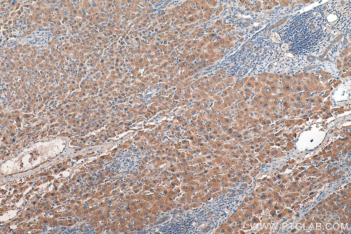 Immunohistochemistry (IHC) staining of human liver cancer tissue using GPX7 Polyclonal antibody (13501-1-AP)