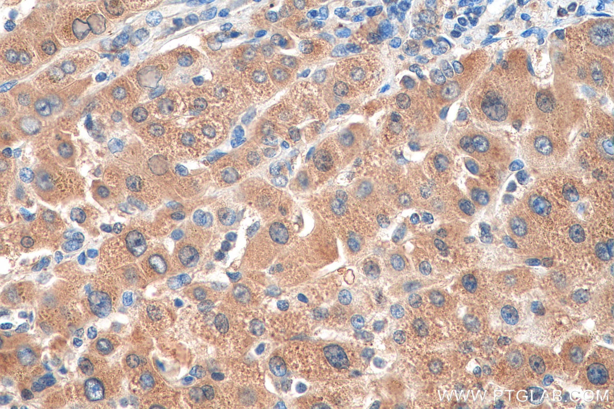 Immunohistochemistry (IHC) staining of human liver cancer tissue using GPX7 Polyclonal antibody (13501-1-AP)