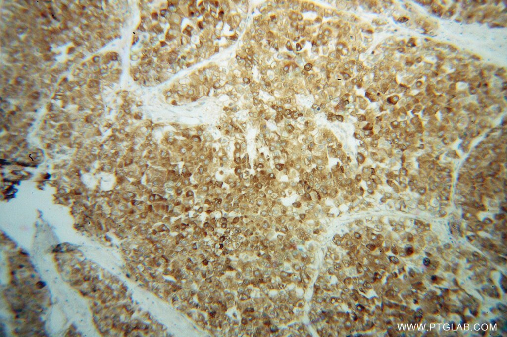 Immunohistochemistry (IHC) staining of human liver cancer tissue using GPX7 Polyclonal antibody (13501-1-AP)