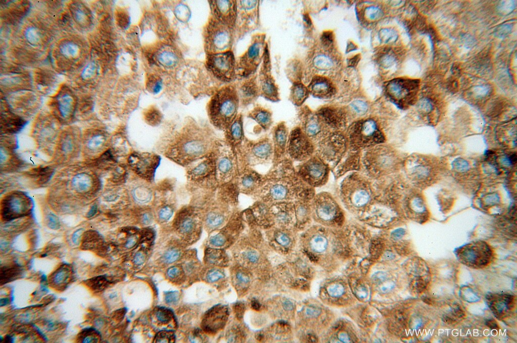 Immunohistochemistry (IHC) staining of human liver cancer tissue using GPX7 Polyclonal antibody (13501-1-AP)