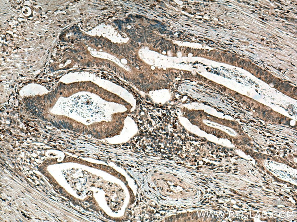 Immunohistochemistry (IHC) staining of human stomach cancer tissue using GPX8 Polyclonal antibody (16846-1-AP)