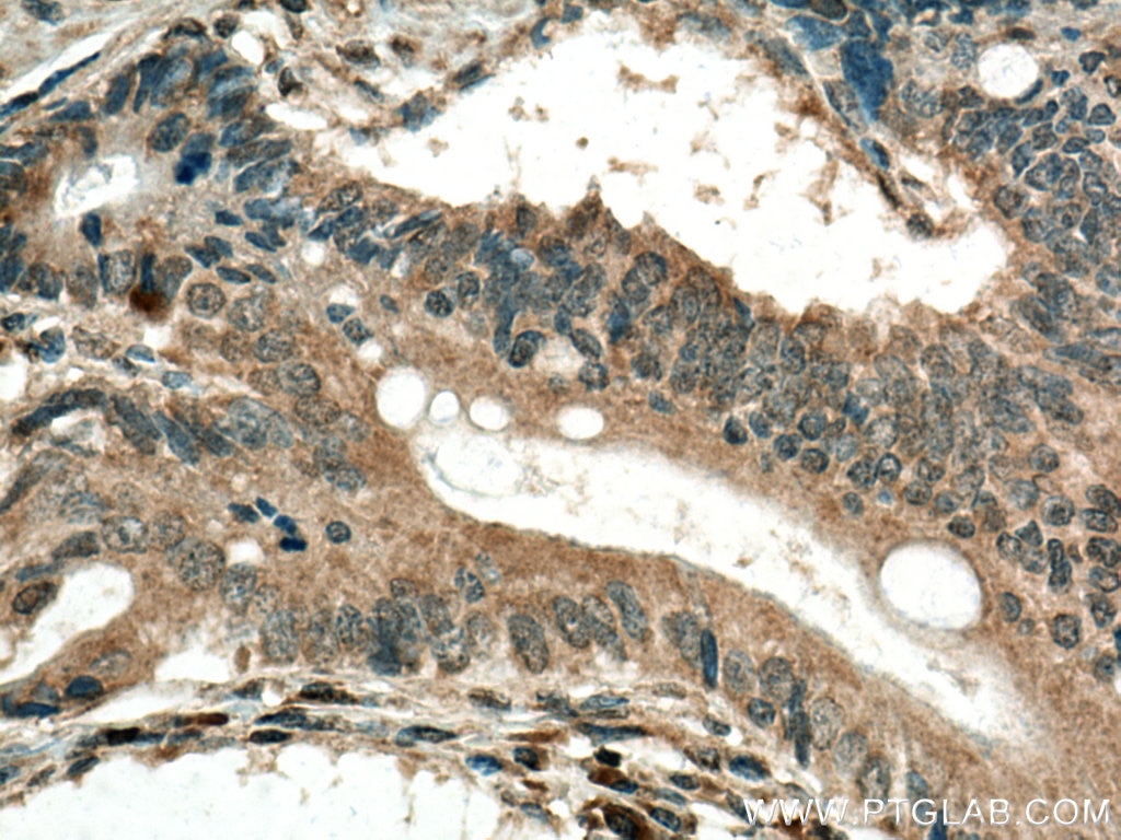 Immunohistochemistry (IHC) staining of human stomach cancer tissue using GPX8 Polyclonal antibody (16846-1-AP)