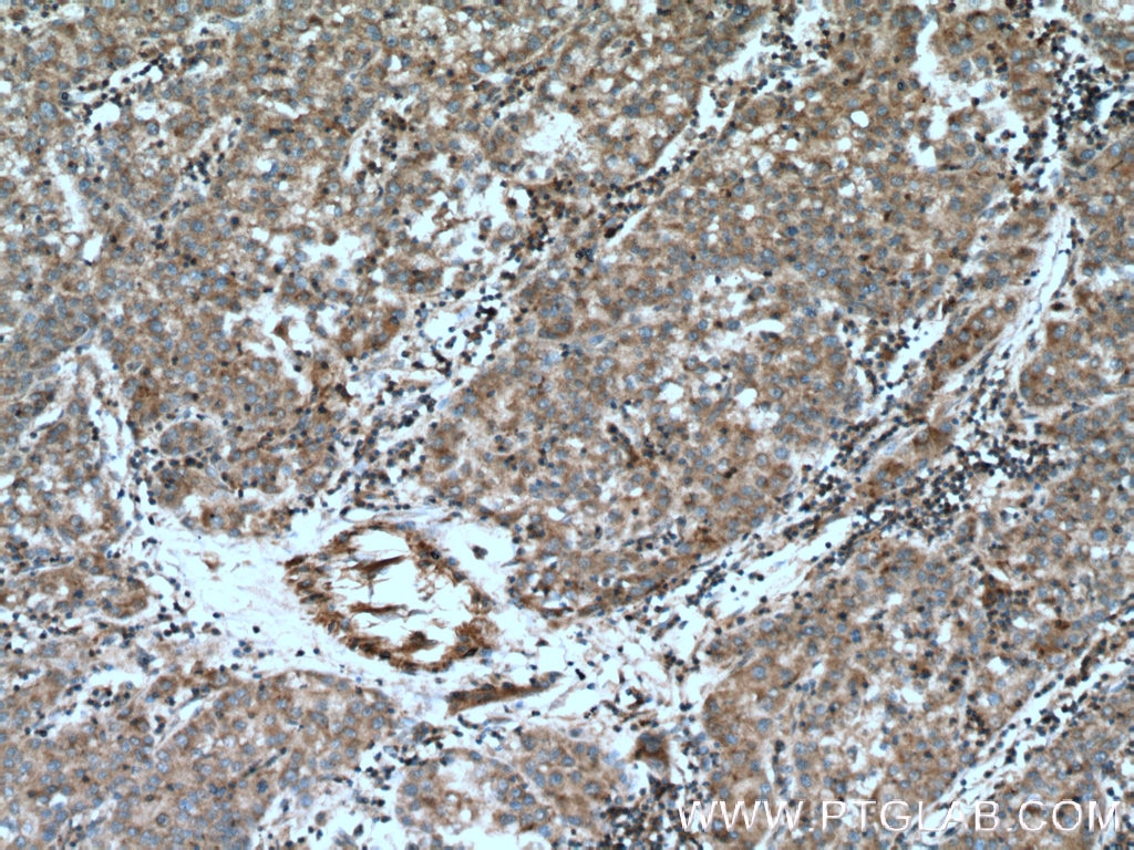 Immunohistochemistry (IHC) staining of human liver cancer tissue using GRAMD1B Polyclonal antibody (24905-1-AP)