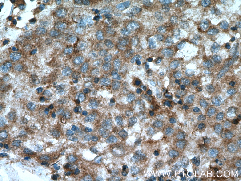 Immunohistochemistry (IHC) staining of human liver cancer tissue using GRAMD1B Polyclonal antibody (24905-1-AP)