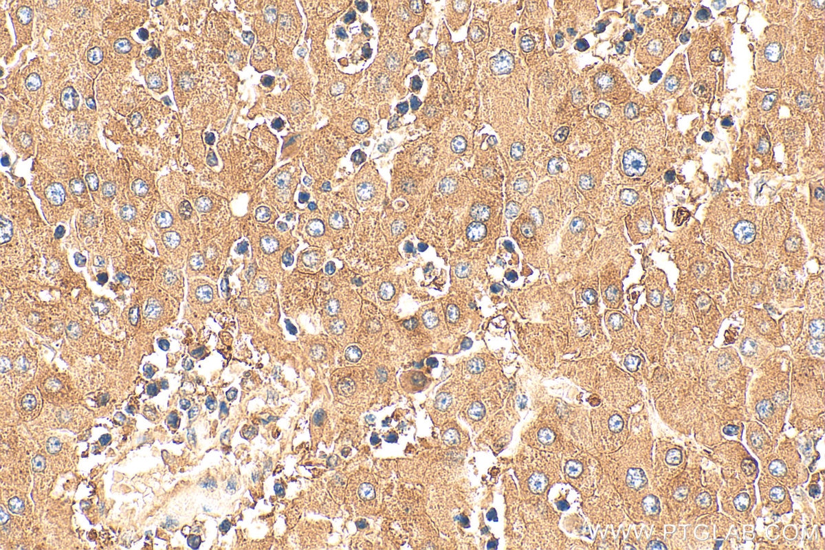 Immunohistochemistry (IHC) staining of human liver cancer tissue using GRAMD4 Polyclonal antibody (24299-1-AP)