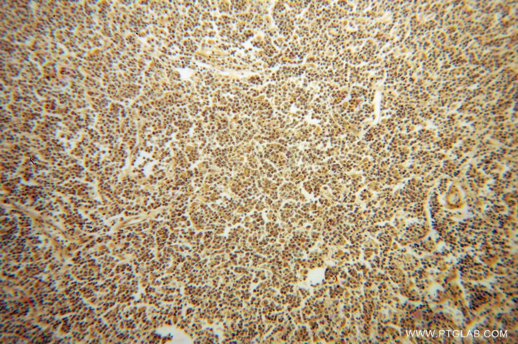 Immunohistochemistry (IHC) staining of human lymphoma tissue using GRAP Polyclonal antibody (14505-1-AP)