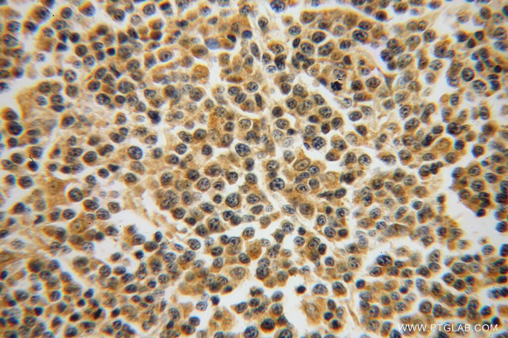 IHC staining of human lymphoma using 14505-1-AP