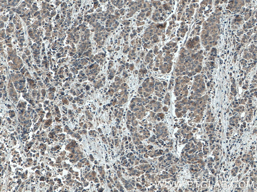 IHC staining of human prostate cancer using 66651-1-Ig