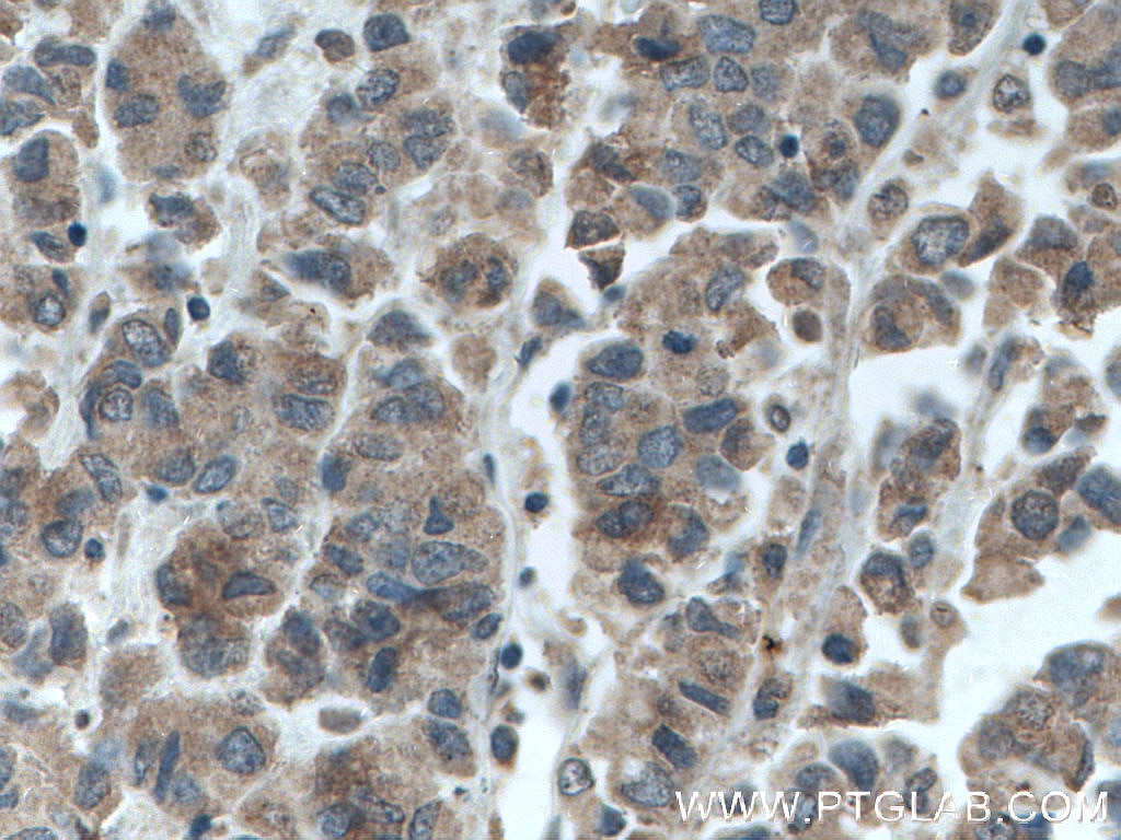 Immunohistochemistry (IHC) staining of human prostate cancer tissue using GRASP65,GORASP1 Monoclonal antibody (66651-1-Ig)