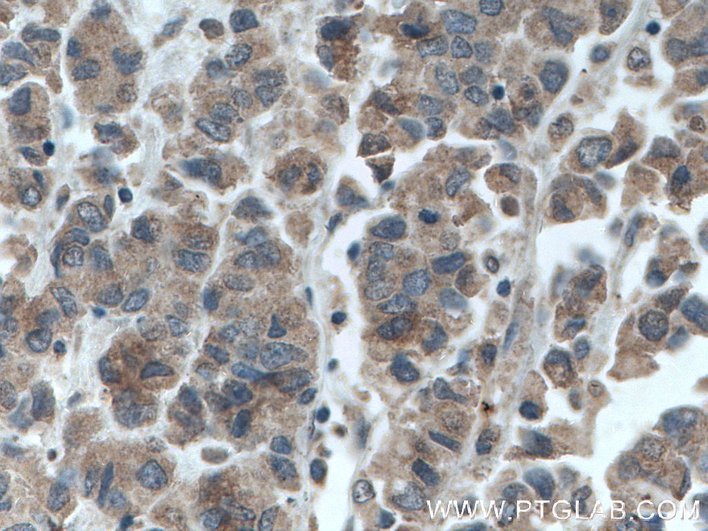 IHC staining of human prostate cancer using 66651-1-Ig