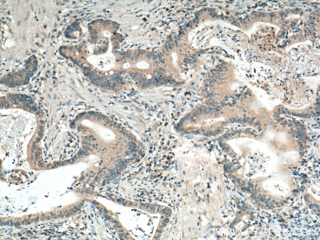 Immunohistochemistry (IHC) staining of human stomach cancer tissue using GRASP65,GORASP1 Monoclonal antibody (66651-1-Ig)