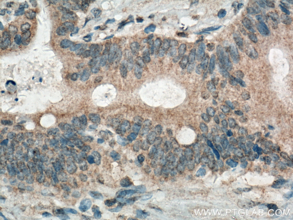 Immunohistochemistry (IHC) staining of human stomach cancer tissue using GRASP65,GORASP1 Monoclonal antibody (66651-1-Ig)