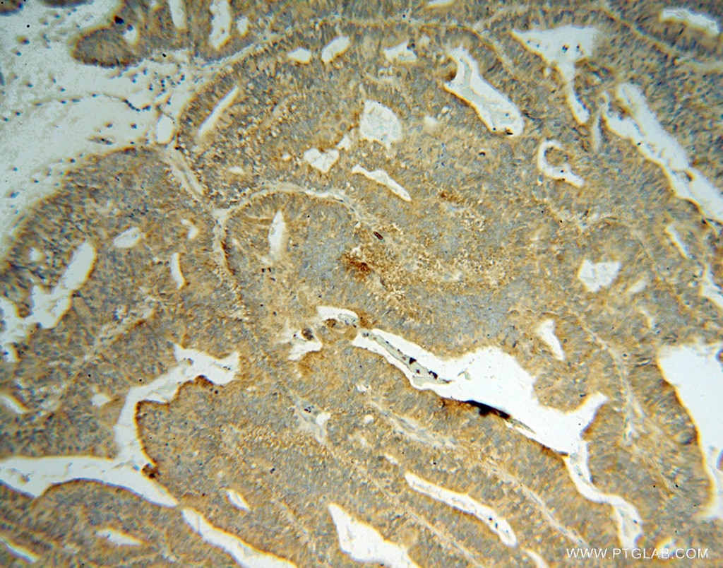 Immunohistochemistry (IHC) staining of human ovary tumor tissue using GRB14 Polyclonal antibody (15298-1-AP)