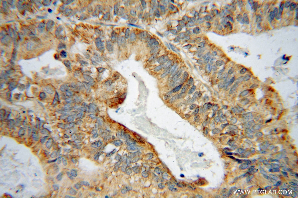 Immunohistochemistry (IHC) staining of human ovary tumor tissue using GRB14 Polyclonal antibody (15298-1-AP)