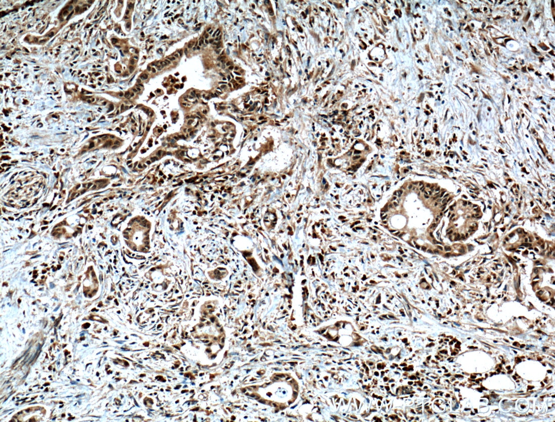 Immunohistochemistry (IHC) staining of human pancreas cancer tissue using GRB2 Polyclonal antibody (10254-2-AP)