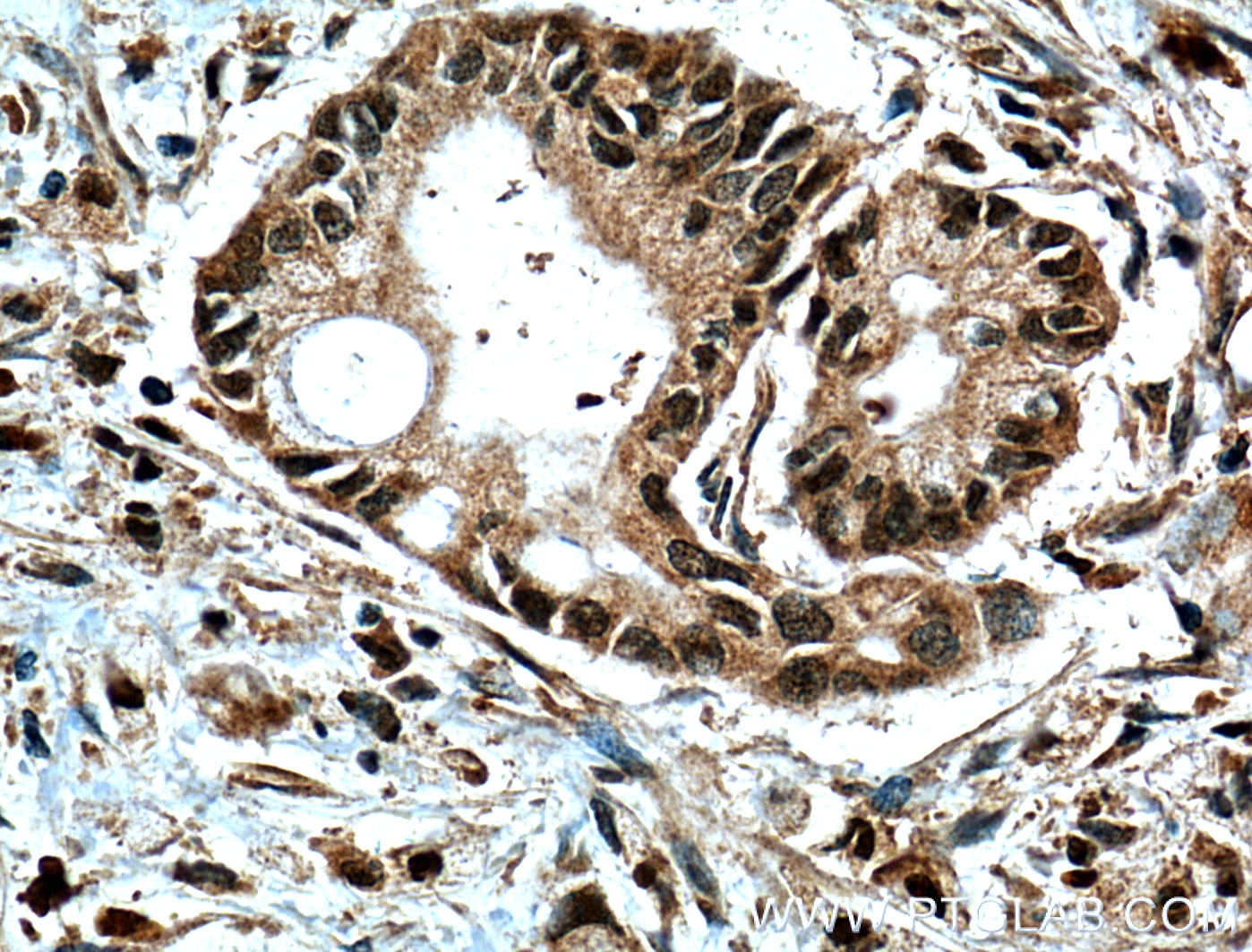 Immunohistochemistry (IHC) staining of human pancreas cancer tissue using GRB2 Polyclonal antibody (10254-2-AP)