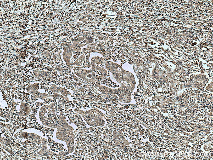 Immunohistochemistry (IHC) staining of human pancreas cancer tissue using GRB2 Monoclonal antibody (66880-1-Ig)
