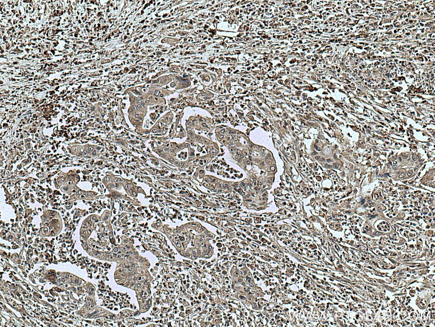 IHC staining of human pancreas cancer using 66880-1-Ig