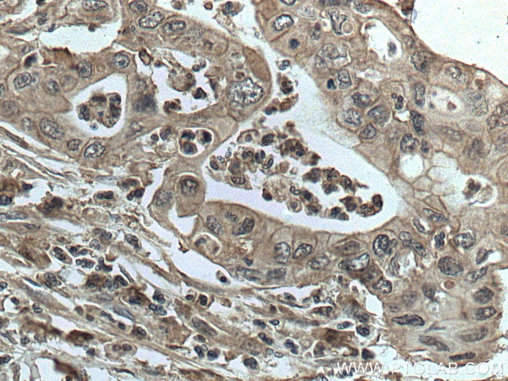 Immunohistochemistry (IHC) staining of human pancreas cancer tissue using GRB2 Monoclonal antibody (66880-1-Ig)