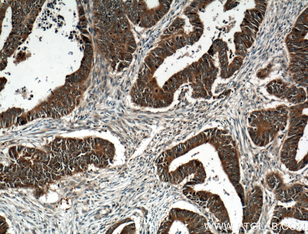 Immunohistochemistry (IHC) staining of human colon cancer tissue using GRB7 Polyclonal antibody (10045-1-Ig)