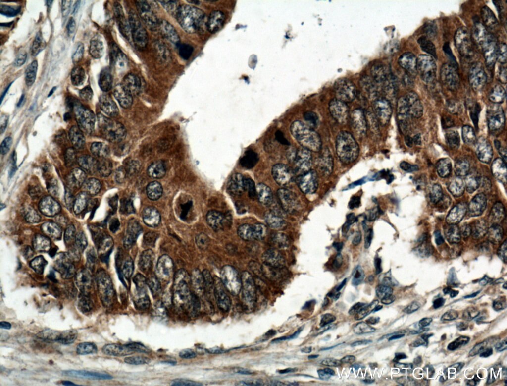 Immunohistochemistry (IHC) staining of human colon cancer tissue using GRB7 Polyclonal antibody (10045-1-Ig)