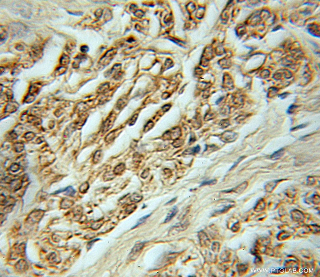 Immunohistochemistry (IHC) staining of human ovary tumor tissue using GRHPR Polyclonal antibody (51013-2-AP)