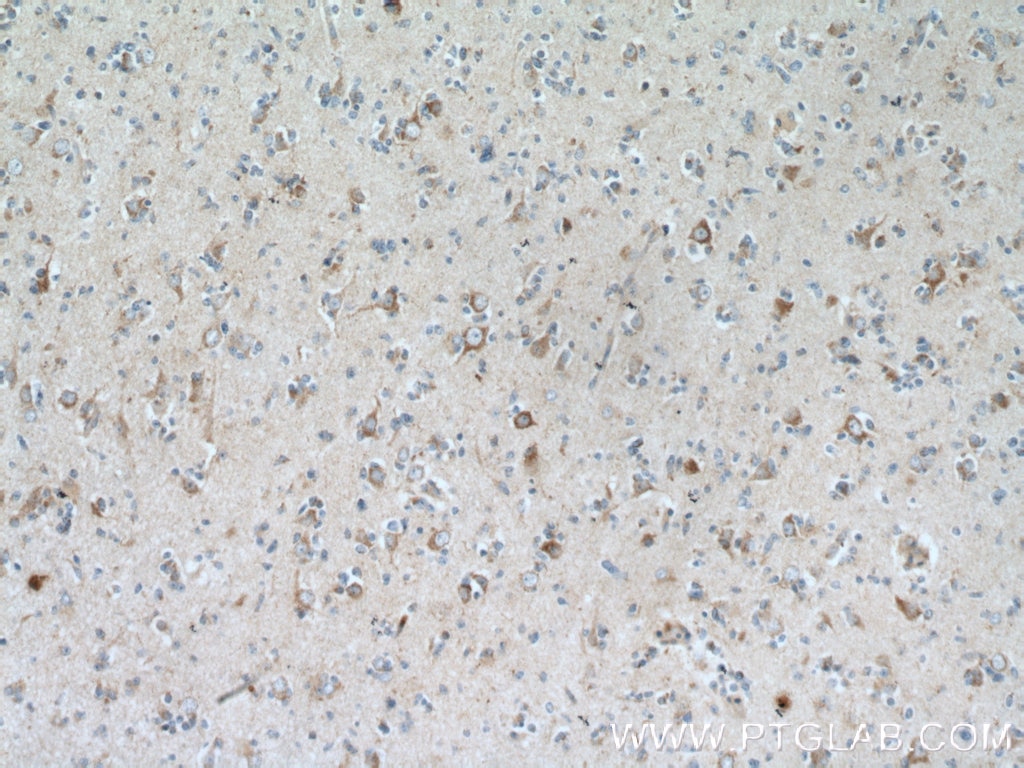 Immunohistochemistry (IHC) staining of human gliomas tissue using GRID1 Polyclonal antibody (13040-1-AP)