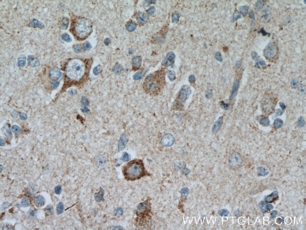 Immunohistochemistry (IHC) staining of human gliomas tissue using GRID1 Polyclonal antibody (13040-1-AP)