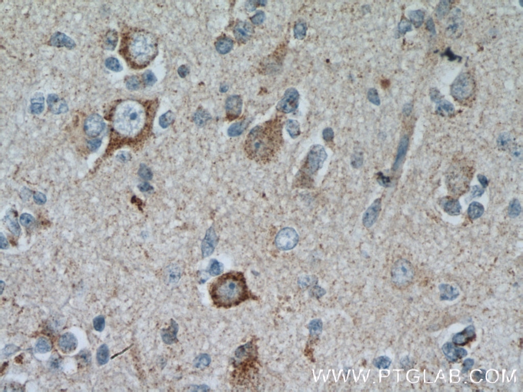 IHC staining of human gliomas using 13040-1-AP