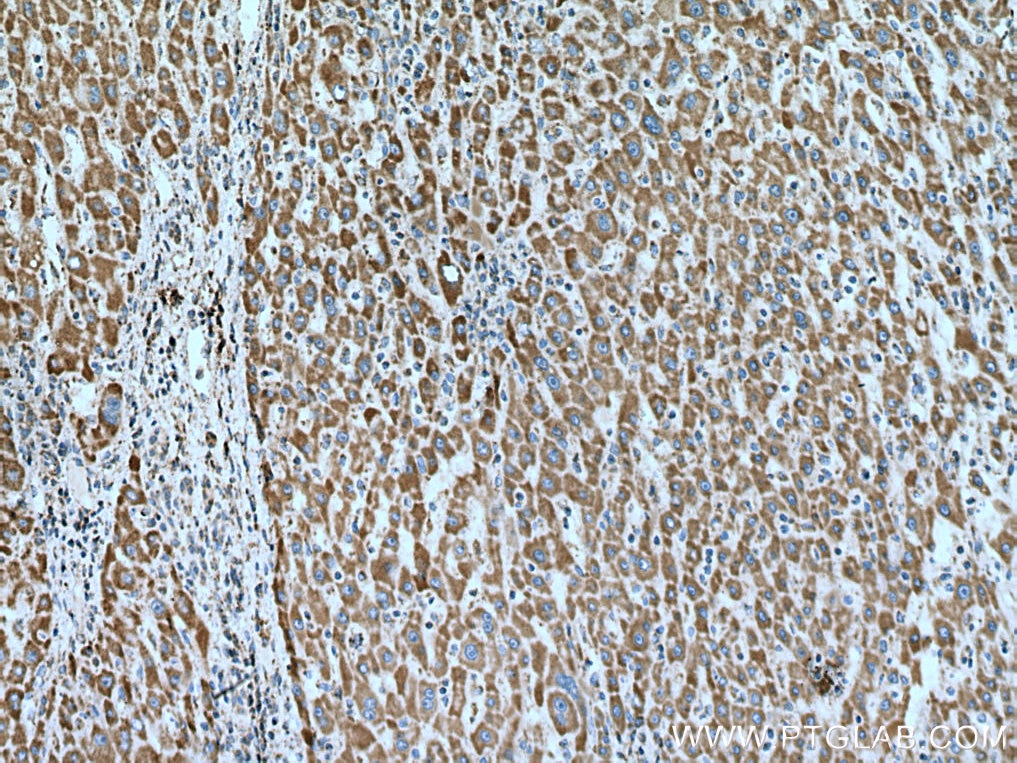 Immunohistochemistry (IHC) staining of human liver cancer tissue using GRIM19 Monoclonal antibody (67414-1-Ig)