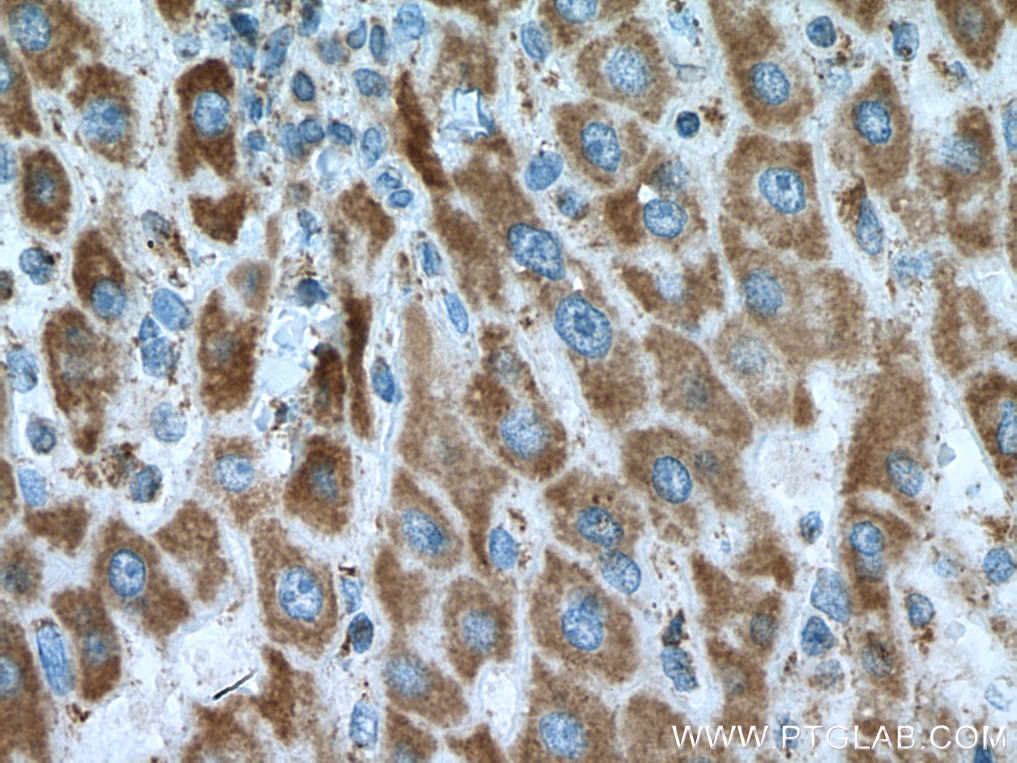Immunohistochemistry (IHC) staining of human liver cancer tissue using GRIM19 Monoclonal antibody (67414-1-Ig)