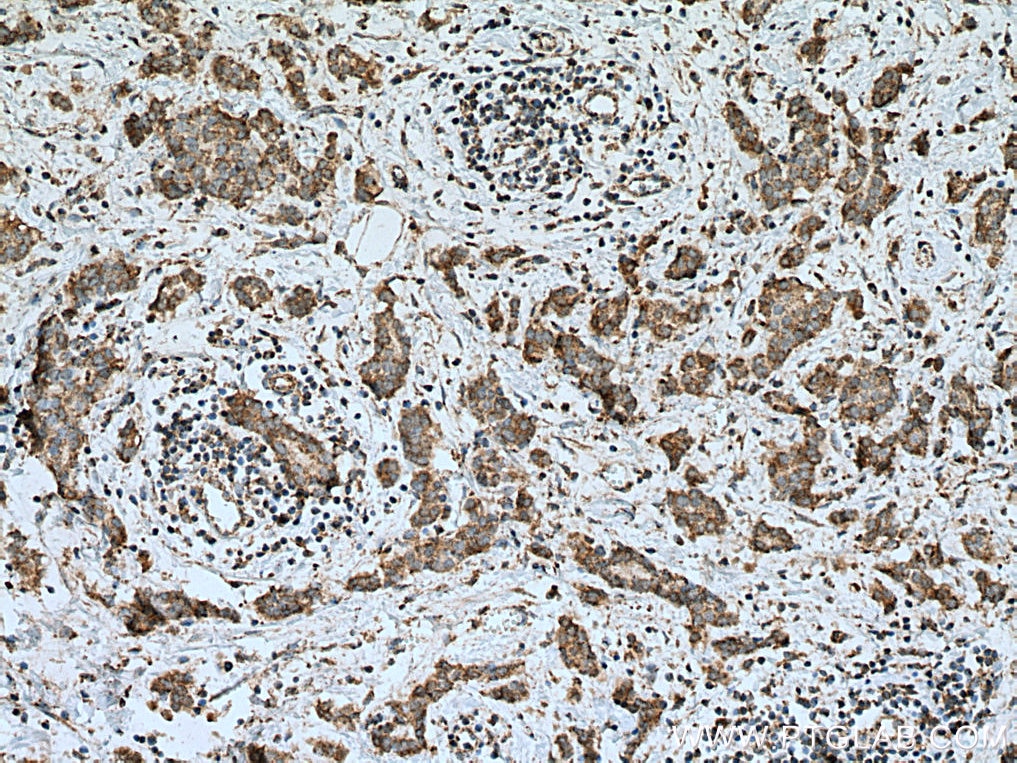 Immunohistochemistry (IHC) staining of human breast cancer tissue using GRIM19 Monoclonal antibody (67414-1-Ig)