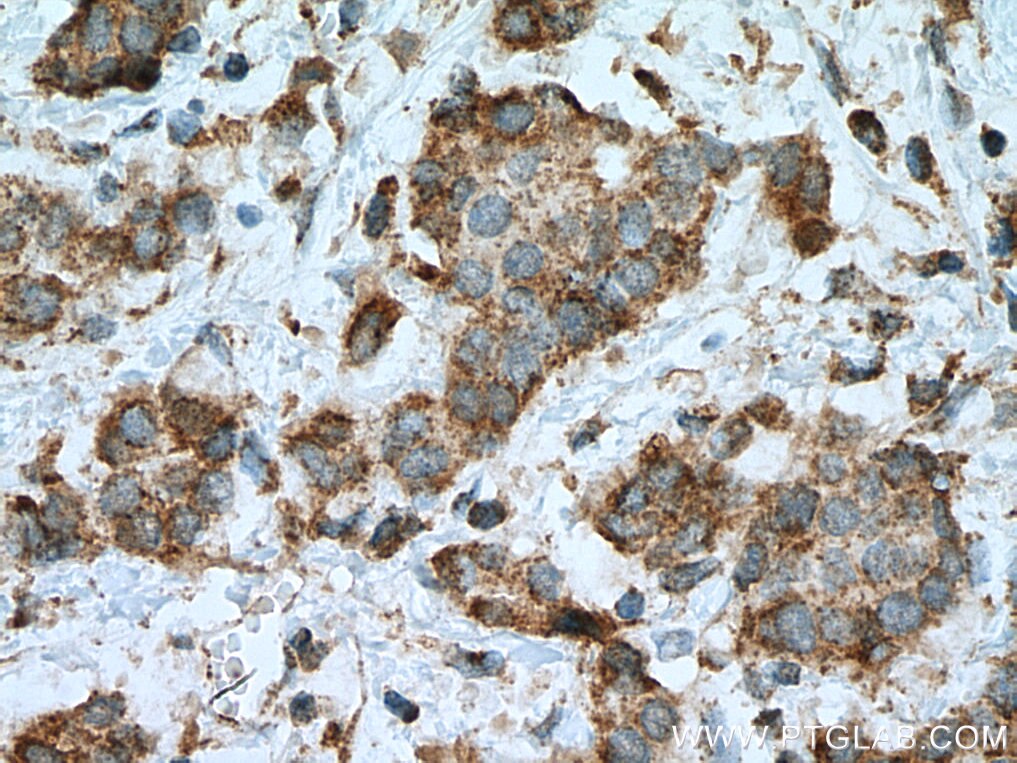 Immunohistochemistry (IHC) staining of human breast cancer tissue using GRIM19 Monoclonal antibody (67414-1-Ig)