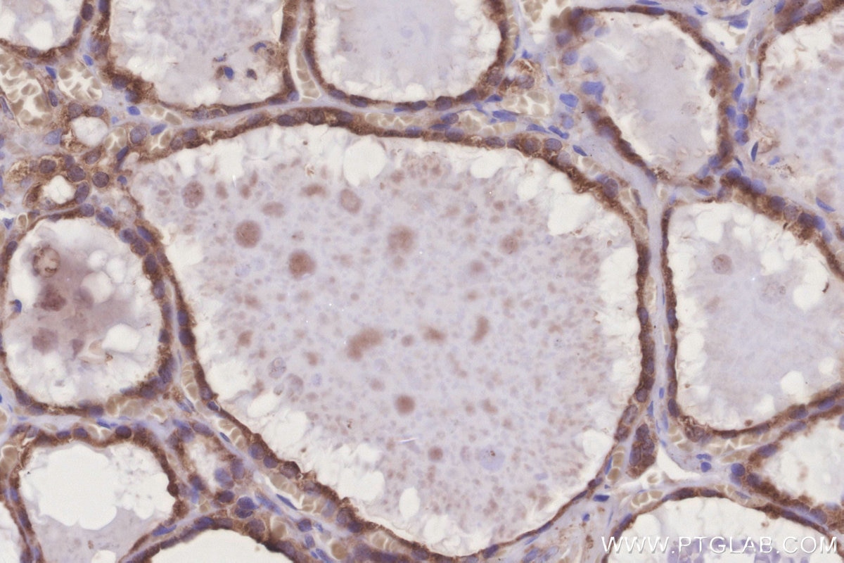 IHC staining of human thyroid cancer using 20851-1-AP Immunohistochemistry (IHC) staining of human thyroid cancer tissue using GRINA Polyclonal antibody (20851-1-AP)