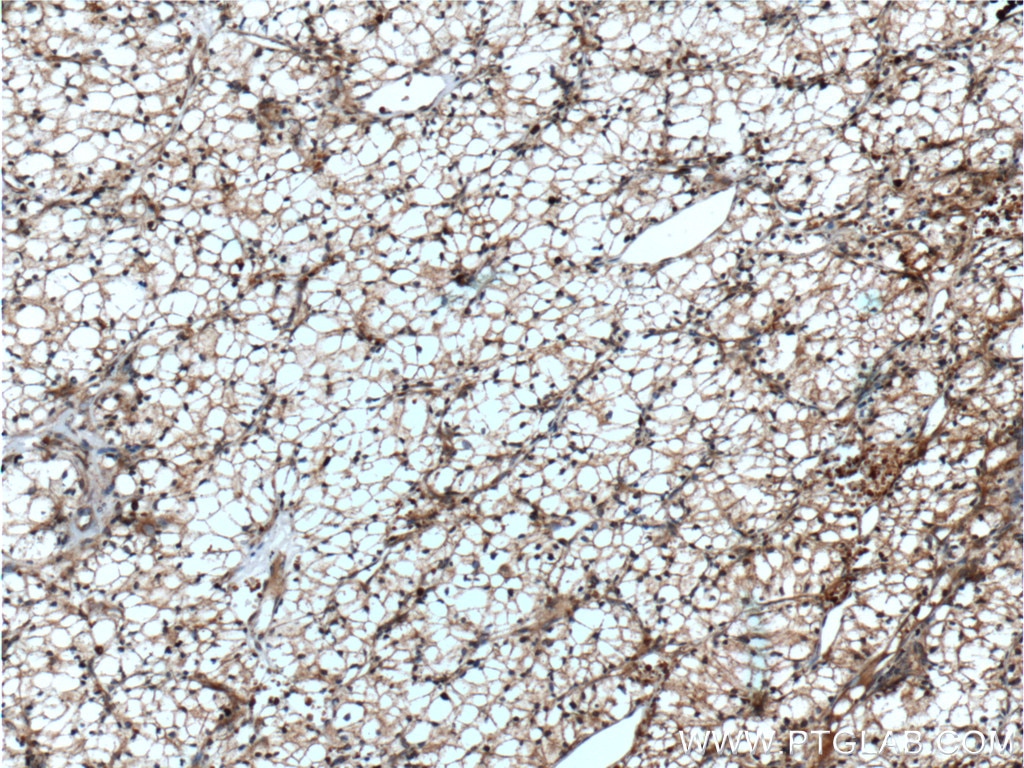 Immunohistochemistry (IHC) staining of human renal cell carcinoma tissue using GRK6 Polyclonal antibody (11439-1-AP)