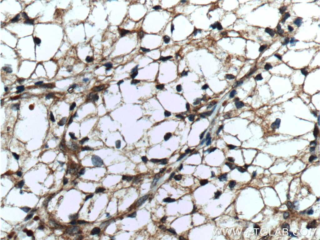 Immunohistochemistry (IHC) staining of human renal cell carcinoma tissue using GRK6 Polyclonal antibody (11439-1-AP)