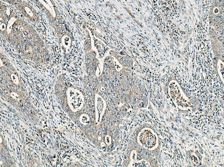 Immunohistochemistry (IHC) staining of human colon cancer tissue using GRP Polyclonal antibody (28482-1-AP)