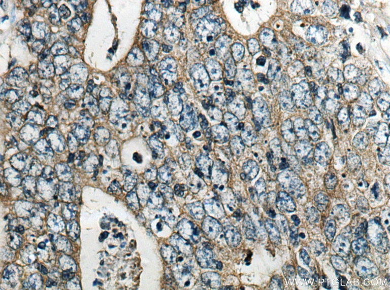 Immunohistochemistry (IHC) staining of human colon cancer tissue using GRP Polyclonal antibody (28482-1-AP)