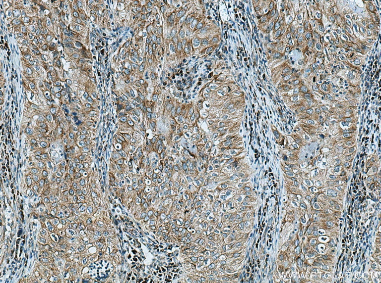Immunohistochemistry (IHC) staining of human lung cancer tissue using GRP Polyclonal antibody (28482-1-AP)
