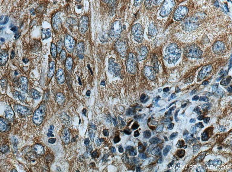 Immunohistochemistry (IHC) staining of human lung cancer tissue using GRP Polyclonal antibody (28482-1-AP)