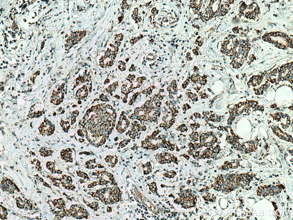 Immunohistochemistry (IHC) staining of human breast cancer tissue using GRP75 Monoclonal antibody (67563-1-Ig)