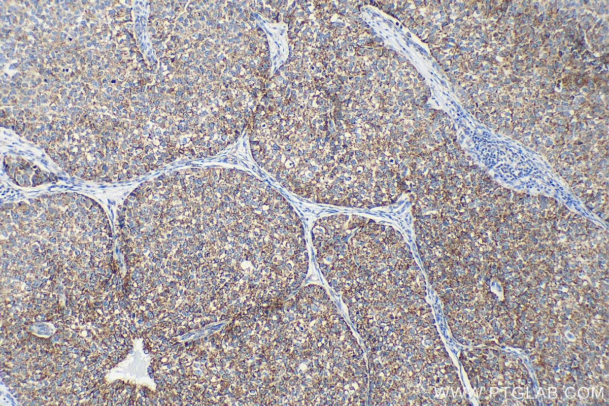 Immunohistochemistry (IHC) staining of human breast cancer tissue using GRP75 Monoclonal antibody (67563-1-Ig)