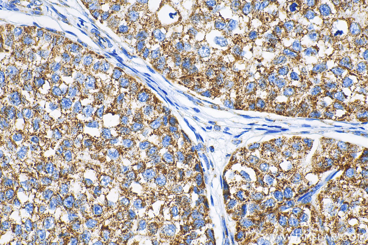 Immunohistochemistry (IHC) staining of human breast cancer tissue using GRP75 Monoclonal antibody (67563-1-Ig)