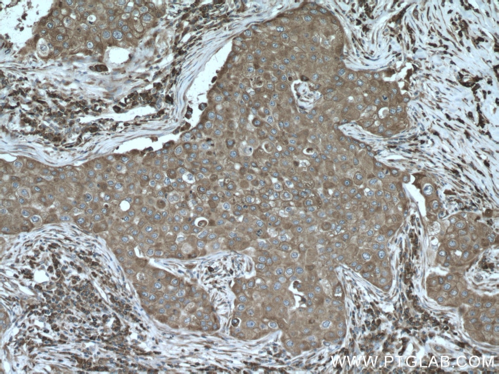 Immunohistochemistry (IHC) staining of human breast cancer tissue using GRP78/BIP Polyclonal antibody (11587-1-AP)